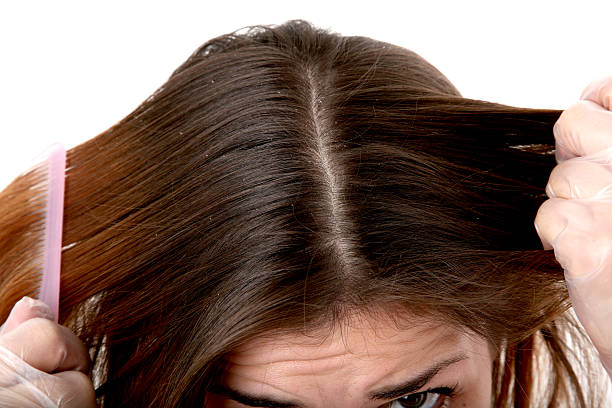 Dandruff Treatment in Dubai: Causes & First Signs