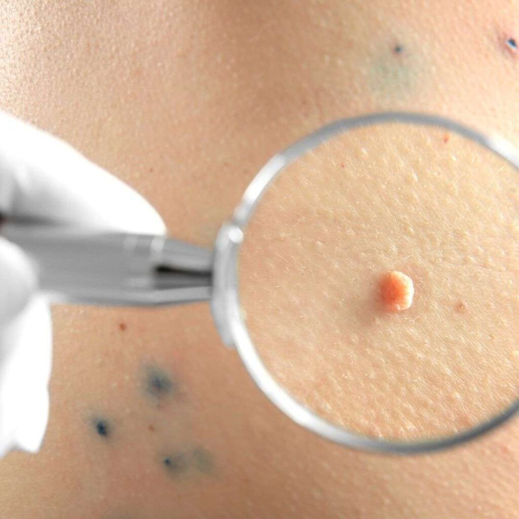 Mole Removal in Dubai: Understanding the Pain and Sensations