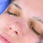 Erbium Peeling in Dubai: How It Resurfaces Skin