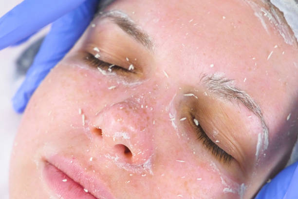 Erbium Peeling in Dubai: How It Resurfaces Skin