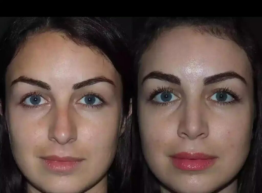 Nose Deviated Septum Surgery in Dubai Health Benefits Guide