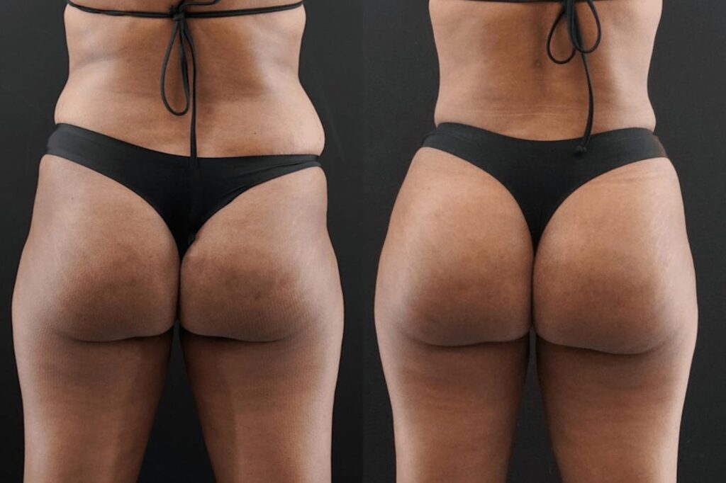Are Butt fillers in Dubai right for improving body curves fast?