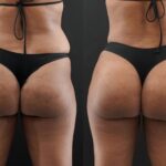 Are Butt fillers in Dubai right for improving body curves fast?