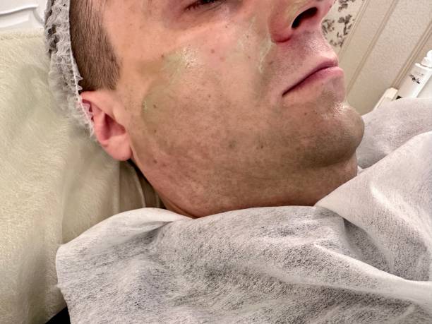 Green Peel Treatment in Dubai: Specialized Care for Men