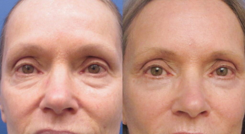 Blepharoplasty Recovery Timeline: What to Expect Day by Day