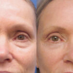 Blepharoplasty Recovery Timeline: What to Expect Day by Day