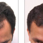 Does Hair Transplant Look Natural After Full Healing?