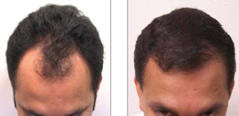 Does Hair Transplant Look Natural After Full Healing?
