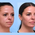 Best Plastic Surgeons in Dubai Offering Customized Thread Lift Technology Treatment