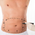 Tummy Tuck in Dubai: Ideal Candidates & Eligibility Guide