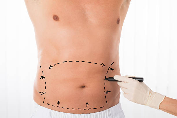 Tummy Tuck in Dubai: Ideal Candidates & Eligibility Guide