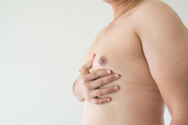 Gynaecomastia Surgery in Dubai: Cost and Value Guide