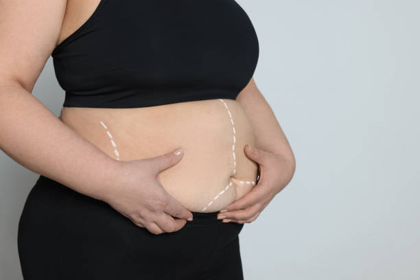 Tummy Tuck Surgery in Dubai: Ideal Age and Timing for Best Results