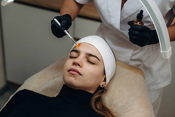 Can Glycolic Peel Treatment in Dubai Fix Acne Scars Effectively?