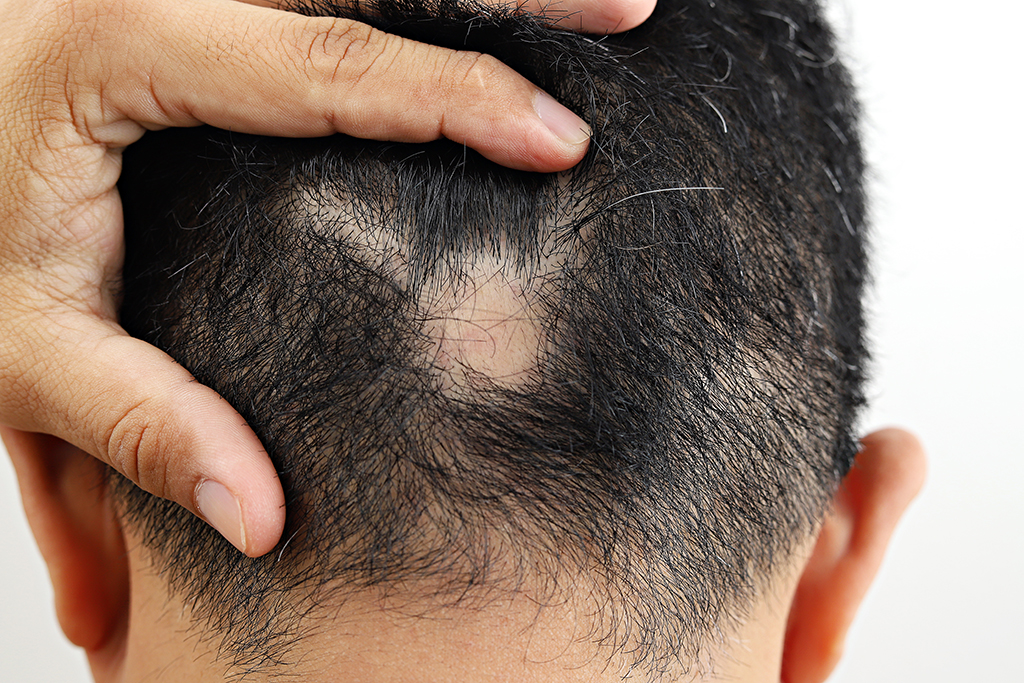How Do Clinics Manage Alopecia Areata with Advanced Treatments in Dubai?
