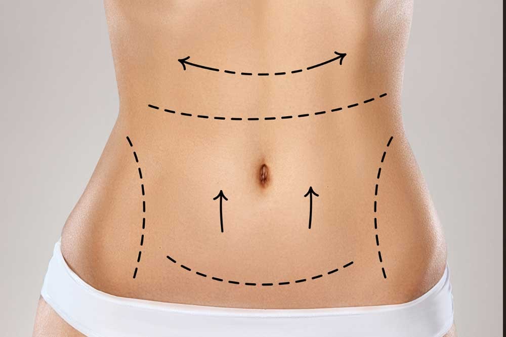 Is Mini Abdominoplasty Suitable for Mild Belly Fat?