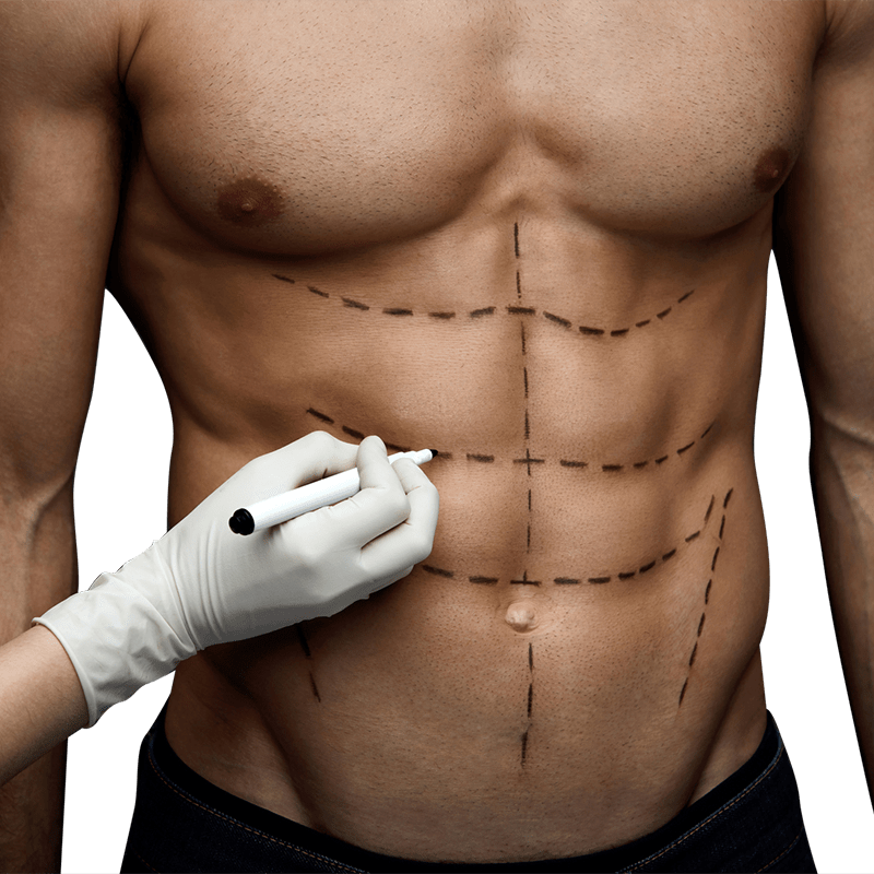 Who Is the Best Candidate for High Definition Liposculpture?