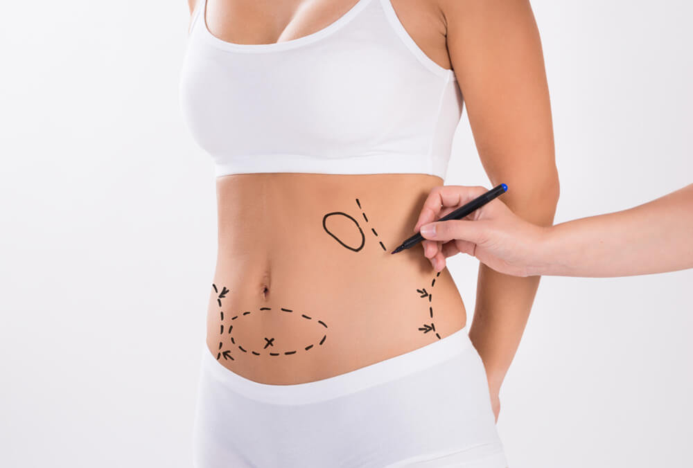 Liposuction in Dubai: Advanced Techniques for Better Outcomes