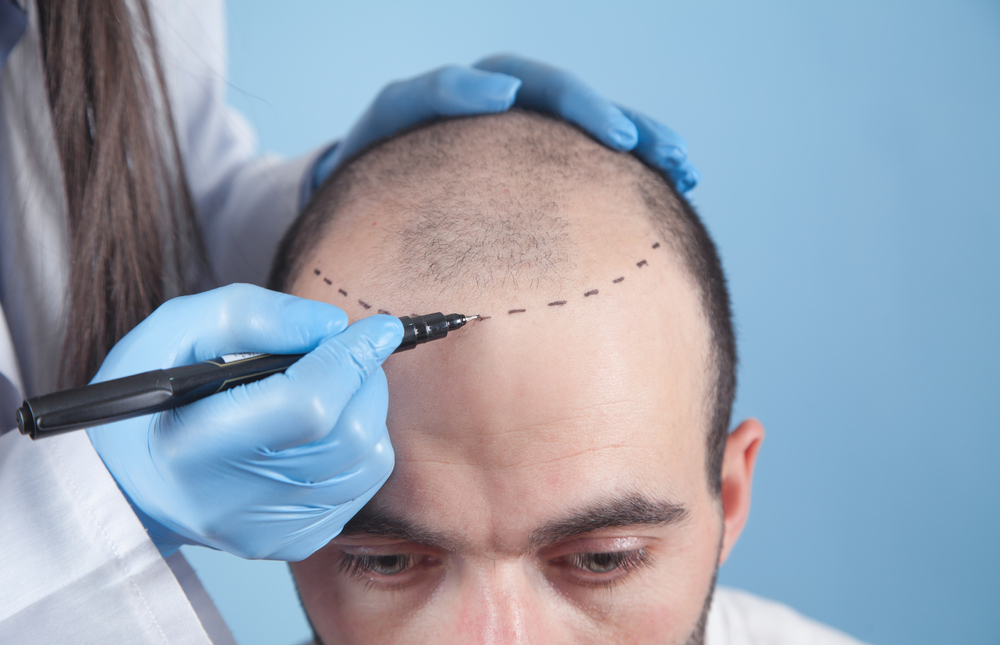 How Do Clinics Achieve High-Graft Survival in Hair Transplant in Dubai?