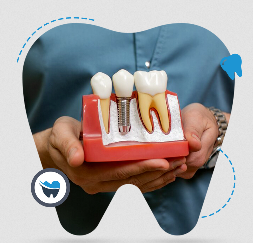 Who Is an Ideal Candidate for Dental Implants?