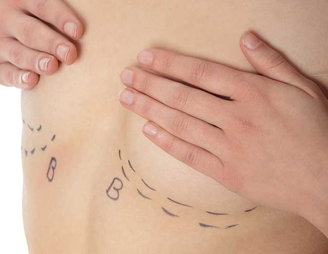 How Long Do Results of Breast Lift Surgery Last Guide?