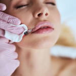 Why Lip Fillers injection creates irresistible lip volume appeal?