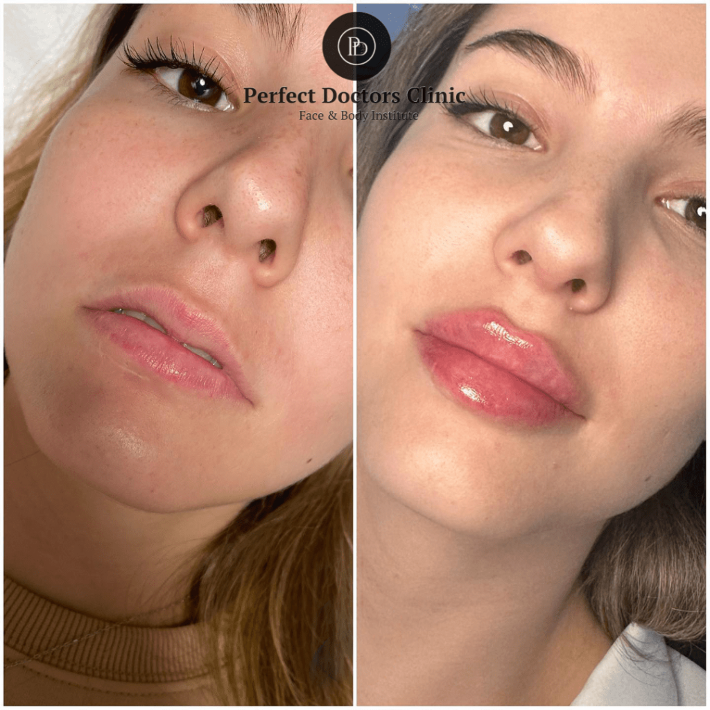 Juvederm Lip Enhancement Trends at the Best Aesthetic Clinic in Dubai