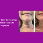 HIFU for Body Contouring: Not Just a Face-Lift Anymore