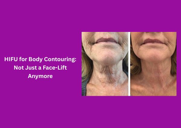 HIFU for Body Contouring: Not Just a Face-Lift Anymore