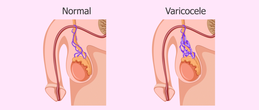 Looking for Varicocele Consultation in Lucknow? Here’s What You Need to Know