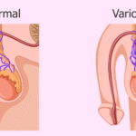 Looking for Varicocele Consultation in Lucknow? Here’s What You Need to Know