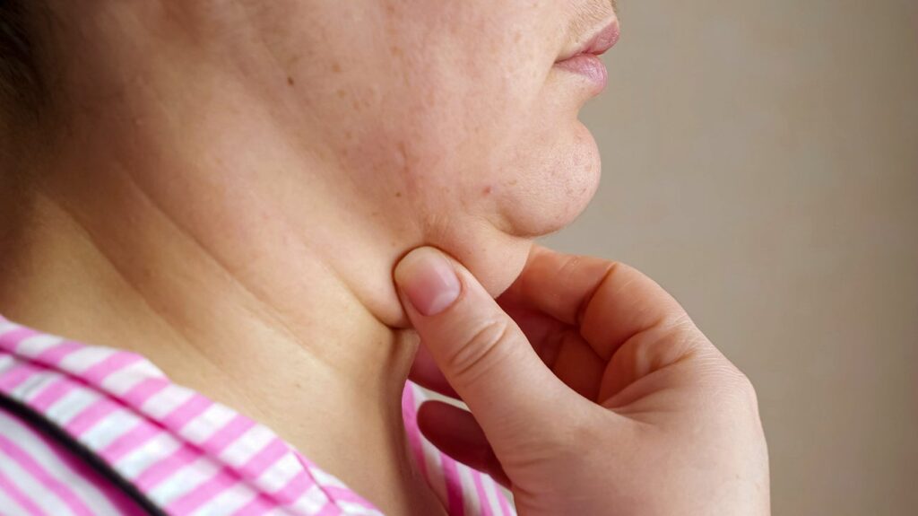 Double Chin Removal: Can Exercise Replace Treatments
