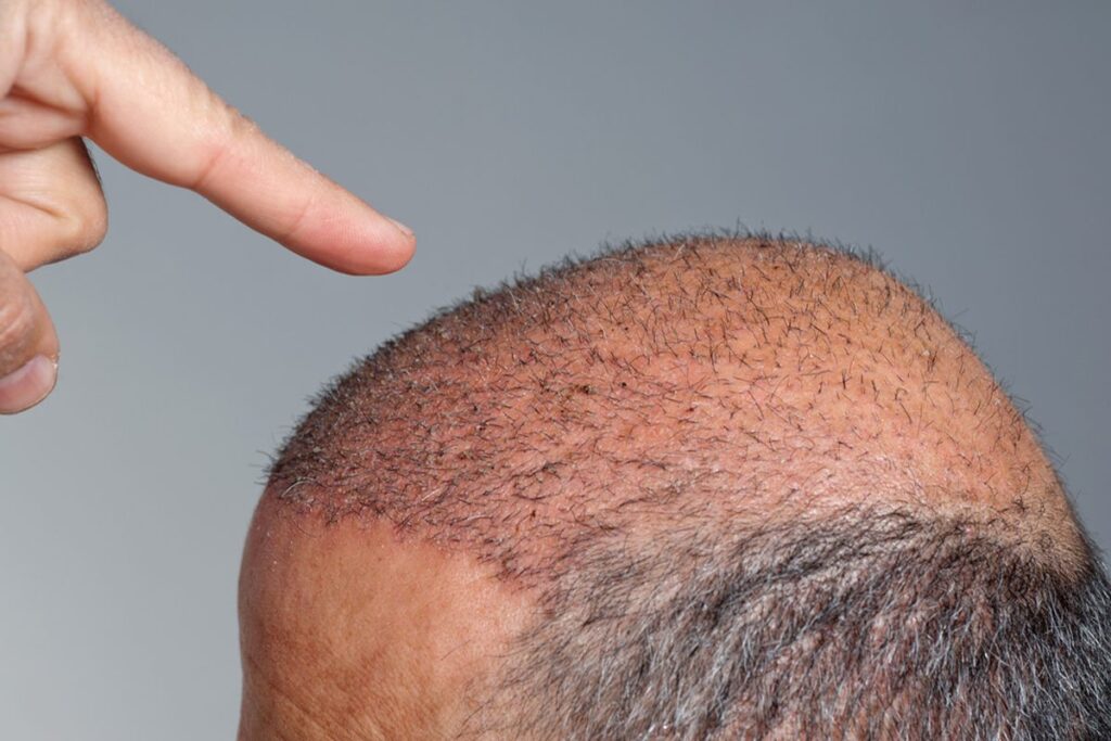 How Long Does a Hybrid Hair Transplant Procedure Take?