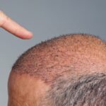 How Long Does a Hybrid Hair Transplant Procedure Take?