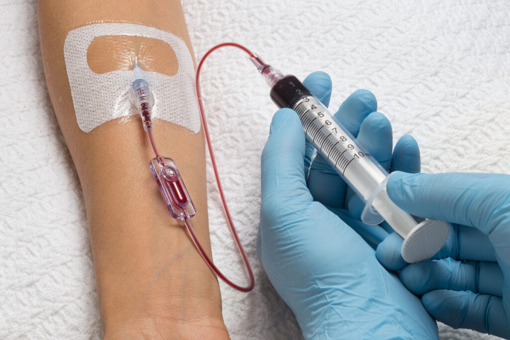 How many sessions of IV ozone therapy are needed post-op?