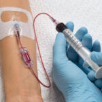 How many sessions of IV ozone therapy are needed post-op?