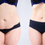 Abdominoplasty Dubai: Patient Success Stories