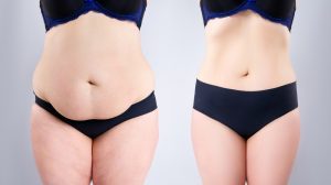Abdominoplasty Dubai: Patient Success Stories