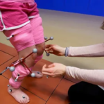Clinical Gait Analysis for Pediatric Foot Health in Edinburgh