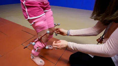 Clinical Gait Analysis for Pediatric Foot Health in Edinburgh