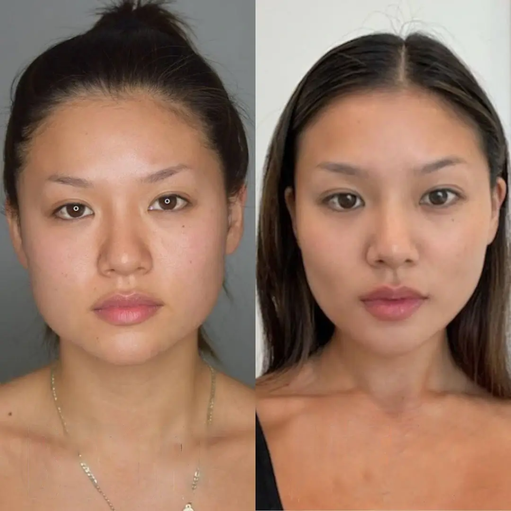 Male vs Female Results of Buccal fat removal Surgery in Dubai