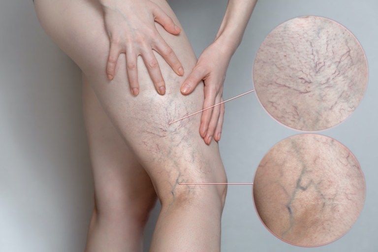 Understanding Spider Veins Treatment for Beginners