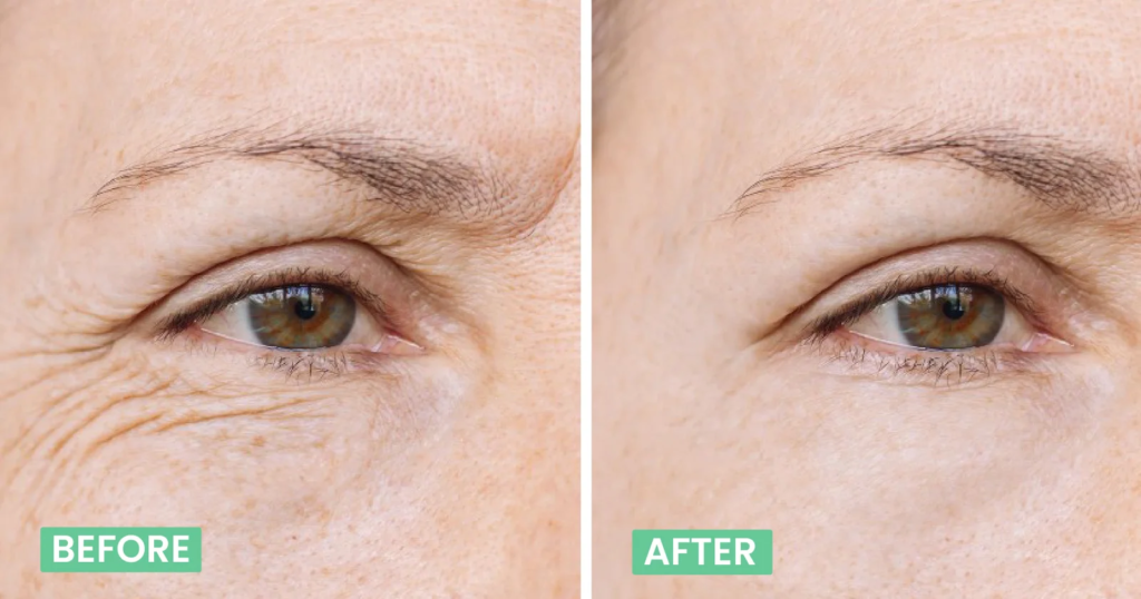 Transform Your Look with the Best Botox Treatment in Bangalore