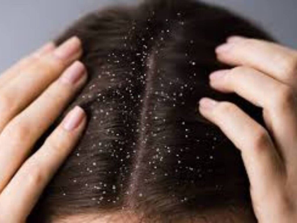 Hidden Causes of Dandruff Most People Ignore