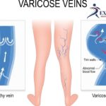 Varicose Veins Laser Treatment in Pune: Costs, Procedures, and Why We Are the Best