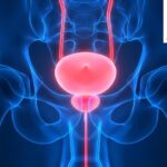 Varicocele Surgery vs Embolization Cost: Making the Right Choice for Your Health