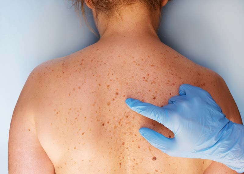 Advanced Skin Cancer Care: Best Dermatology Fort Worth & Mohs Surgery