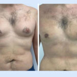 How the Best Gynecomastia Doctors in Dubai for Gynecomastia in Dubai Address Pseudogynecomastia Effectively
