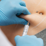What Qualifies Someone for Aqualyx Fat Dissolving Injections?