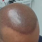What Advanced Equipment Is Used in SMP Procedures Today?